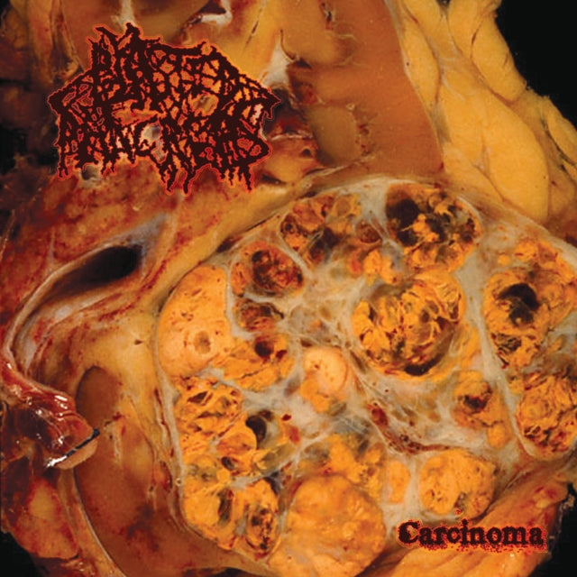 Blasted Pancreas - Carcinoma - LP Vinyl Record